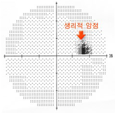 녹내장의 시야