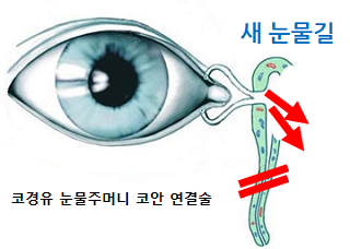 코경유 눈물주머니 코안 연결술